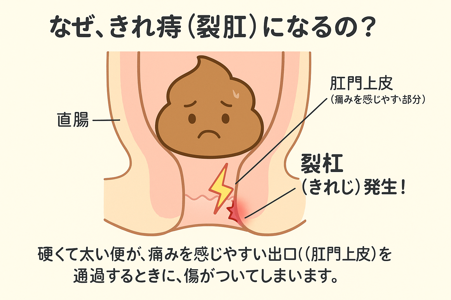 裂肛のメカニズム