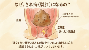 「なぜ、きれ痔（裂肛）になるの？」というタイトルのイラスト。直腸と肛門上皮の断面図で、困った顔の硬そうな便が通過する際、痛みを感じやすい肛門上皮に傷（裂肛）が発生する様子が稲妻マークで描かれている。「直腸」「肛門上皮（痛みを感じやすい部分）」「裂肛（きれじ）発生！」というラベルが付いている。下部には「硬くて太い便が、痛みを感じやすい出口（肛門上皮）を通過するときに、傷がついてしまいます。」という説明文がある。