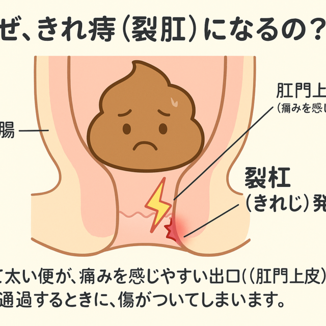 裂肛のメカニズム
