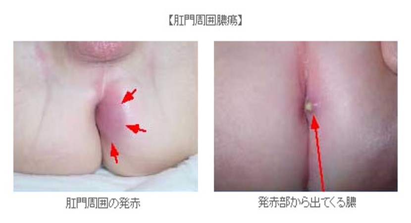 赤ちゃんのお尻のただれ、腫れ(はれ）、膿（うみ）がでる原因：肛門周囲膿瘍（こうもんしゅういのうよう）とは？