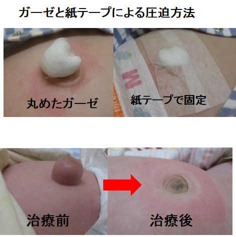赤ちゃん、子どもの外科的病気：臍ヘルニア（出べそ）の圧迫療法の工夫