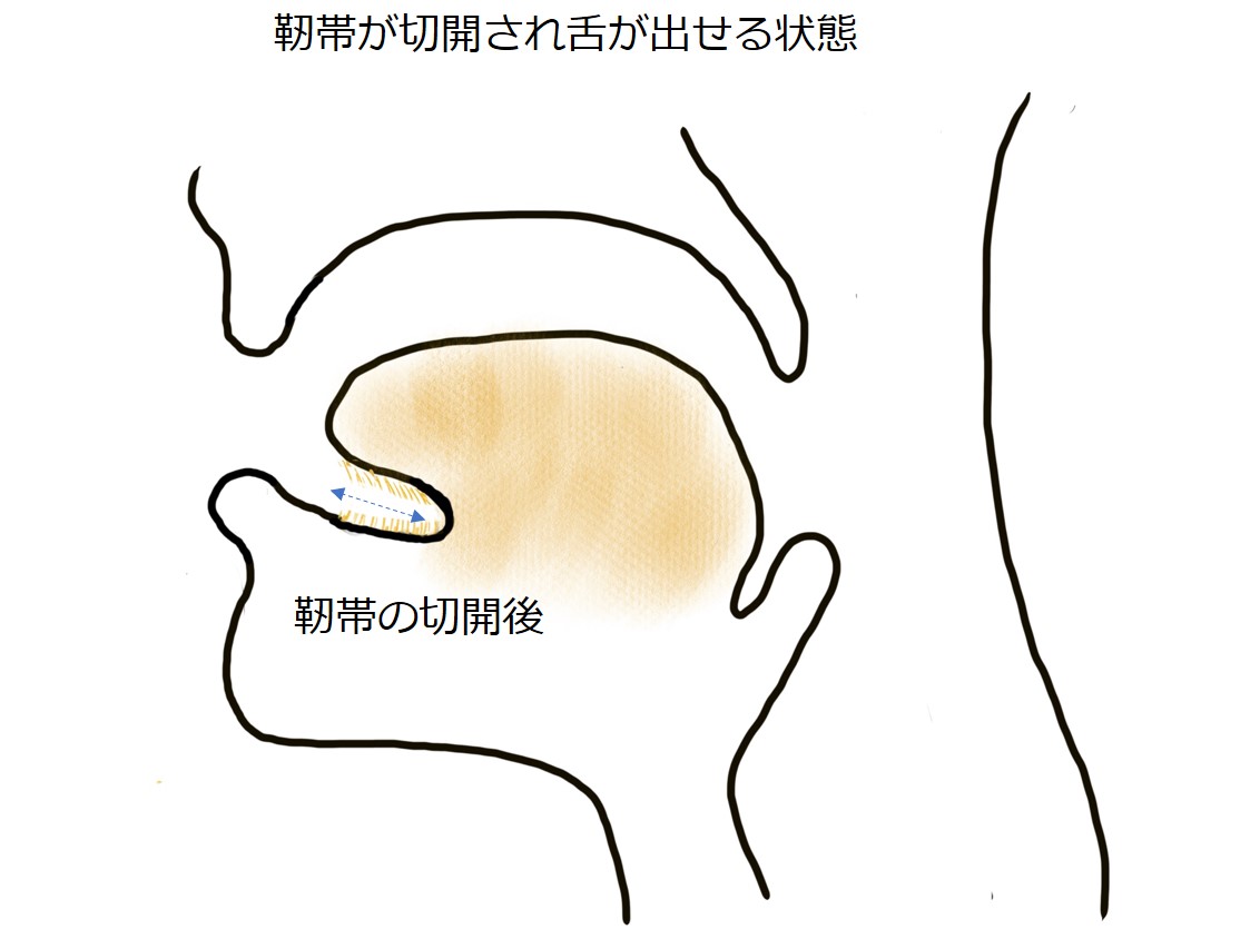 赤ちゃん、子どもの外科的な病気：舌小帯短縮症（ぜつしょうたいたんしゅくしょう）とは？