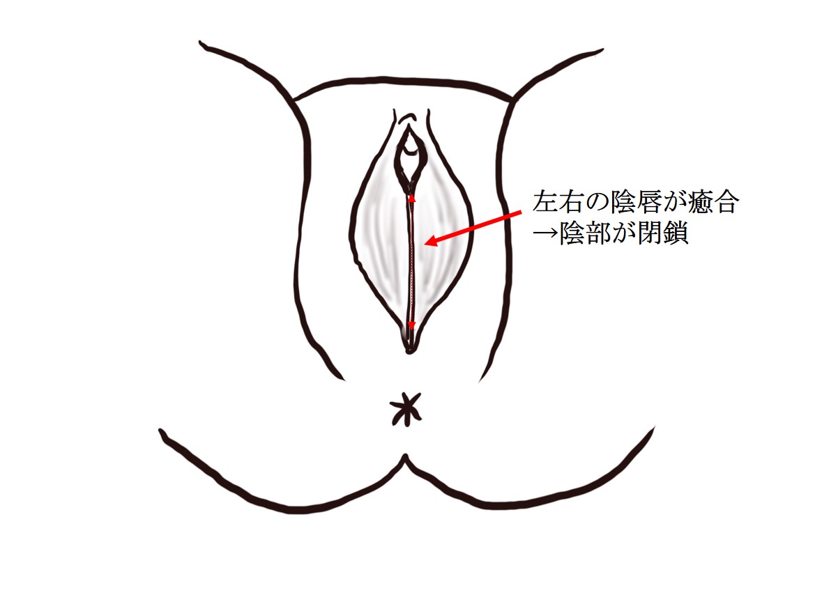 小児の外科疾患:陰唇癒合(いんしんゆごう)の治療について