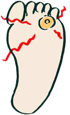 ウイルス性いぼ