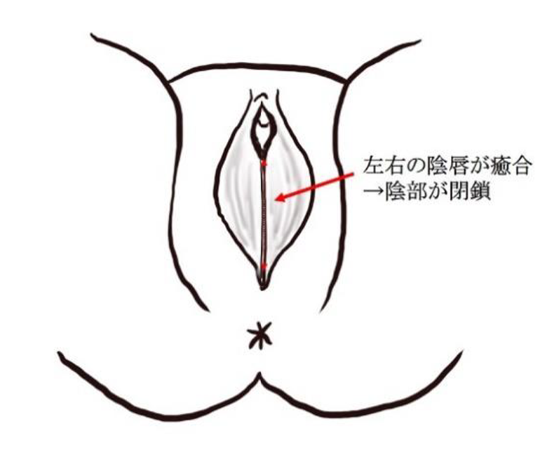 陰唇癒合