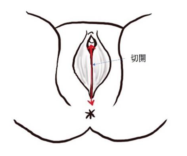 切開