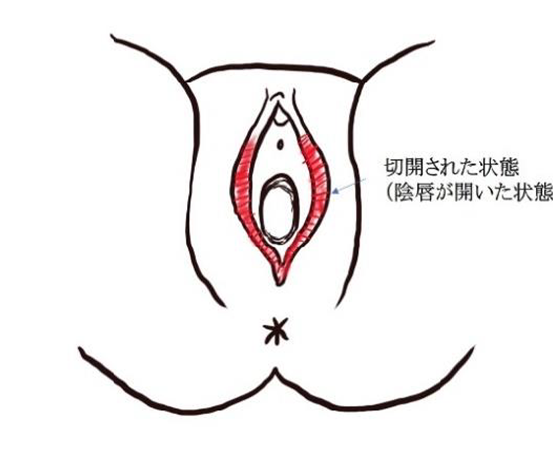 切開された状態