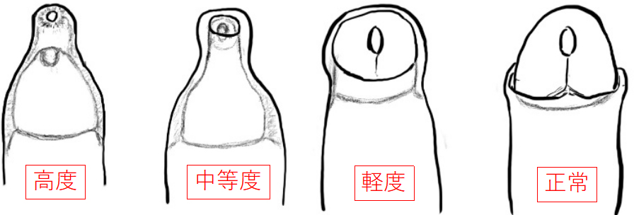 包茎 治療内容