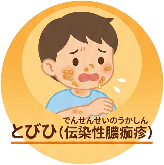 とびひ